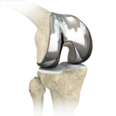 Custom-fitted Total Knee Arthroplasty