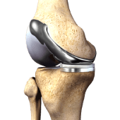 Custom Knee Replacement