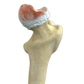 Hip Osteonecrosis