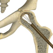 Hip Reconstruction