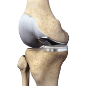 Partial Medial Knee Replacement