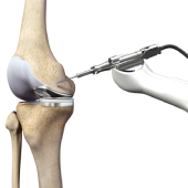 Mako Robotic-Arm Assisted Technology for Total Knee Replacement