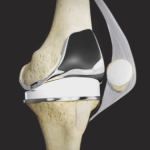 Tricompartmental Knee Replacement