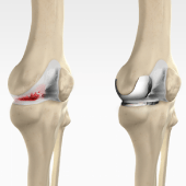 Unicondylar knee Replacement